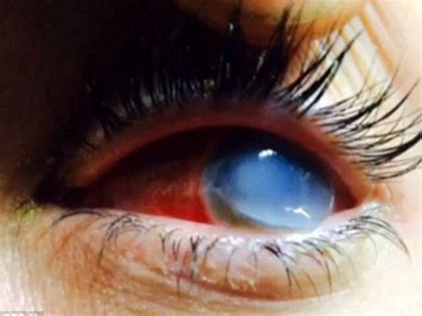 Brittany Williams Goes Blind In One Eye After Catching A Flesh Eating Bacteria During Mud Run