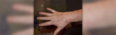 Rash On Hands Skin And Hair Problems Articles Body And Health