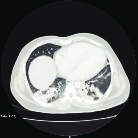 Ct Thorax Depicting Bilateral Lower Lobes Airspace Consolidation