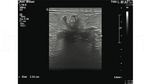 Us Breast Showing Irregular Shaped Lesion With Speculated Margin