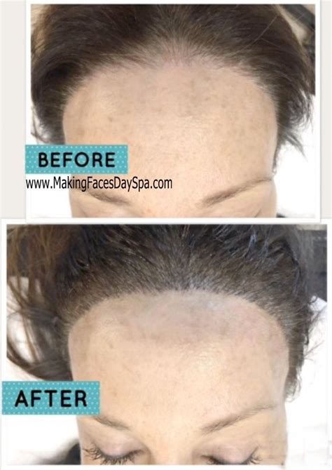 Pin On Microblading Hairline And Bald Spot Restoration