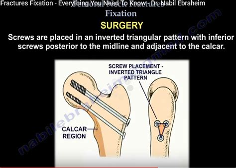 Femoral Neck Fracture Fixation —
