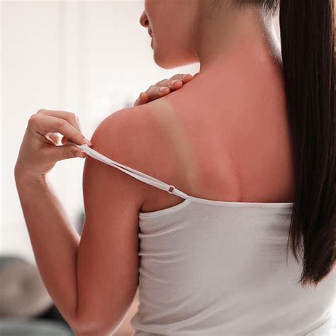 How To Treat Sunburn Forefront Dermatology
