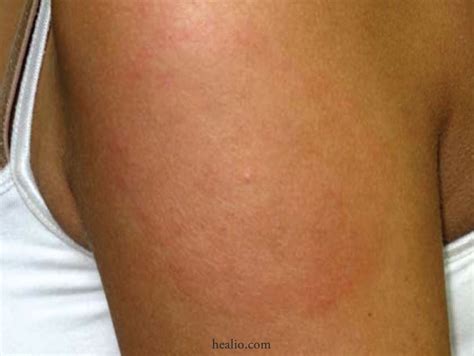 Pin On Lyme Disease Central Mass