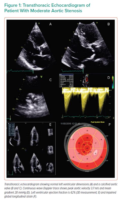 Transthoracic Echocardiogram Of Patient With Moderate Aortic Stenosis