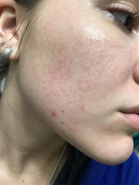 Red Dots On Face Skin Bumps That Look Like Pimples But Aren T What