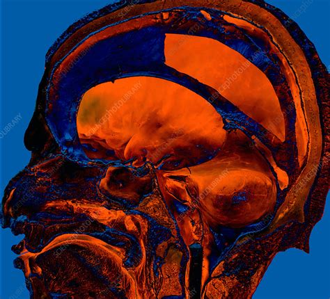Enhanced Cadaver Sagittal Slice Of Brain Stock Image C0365060
