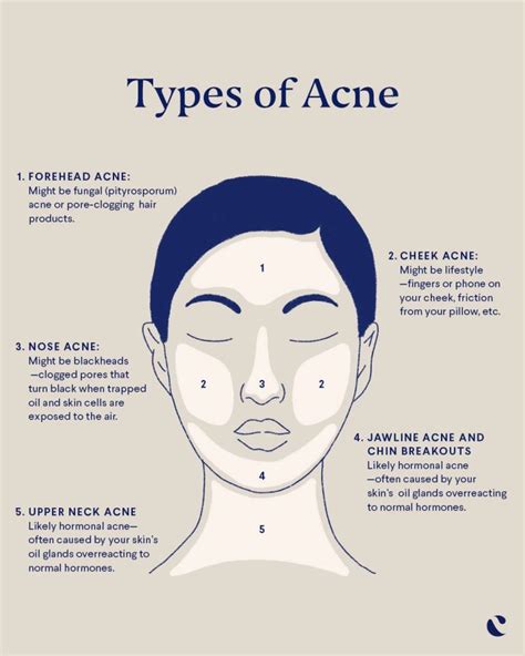 What To Know About Acne Face Mapping Curology Forehead Acne Face