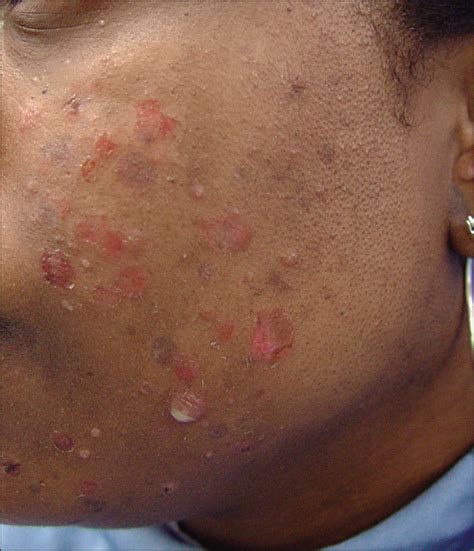 Bullous Impetigo Of The Face After Epilation By Threading Dermatology JAMA Dermatology