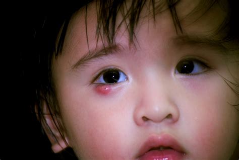 Eye Infection Types Symptoms And Treatments In Babies New Kids Center