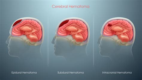 Understanding Hematomas And Traumatic Brain Injury Scientific Animations
