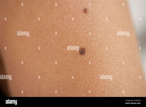 Liver Spots On Female Skin Stock Photo Alamy