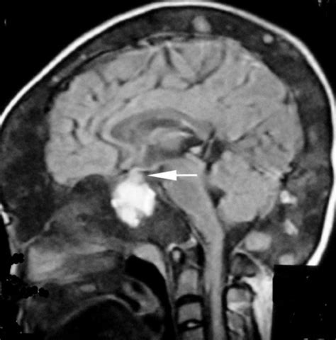 T1 Weighted Coronal Mri Scans Of The Head Normal Pitui Open I