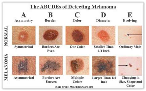 Melanoma Get A Comprehensive Details About Its Prevention