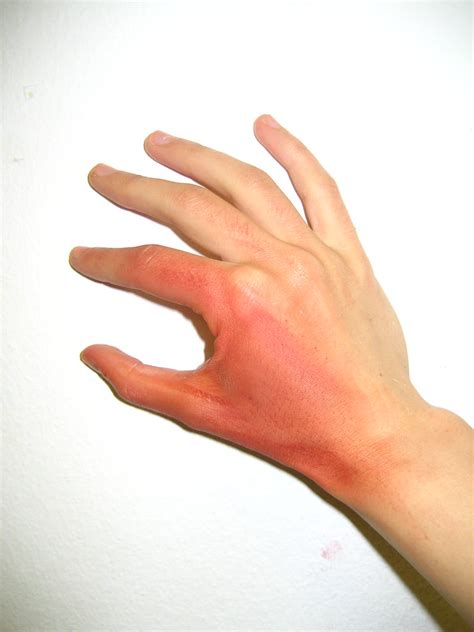 The following is an overview of first and second degree burns, including pathophysiology and treatment. 1st degree burn | Special effects | Mia Truter | Flickr