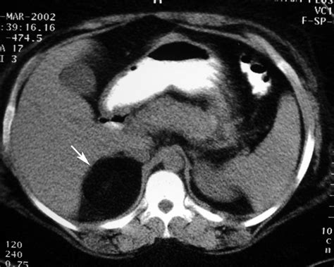 Radiodiagnosis Imaging Is Amazing Interesting Cases Adrenal