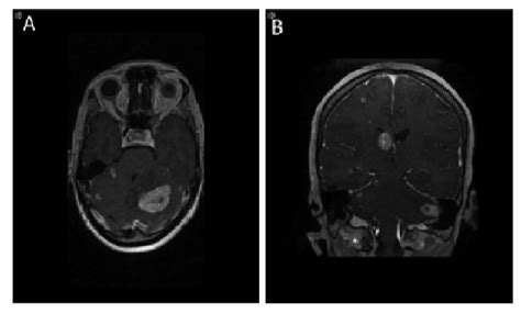 Mri Brain Demonstrating Metastases To Brain Axial A And Coronal B