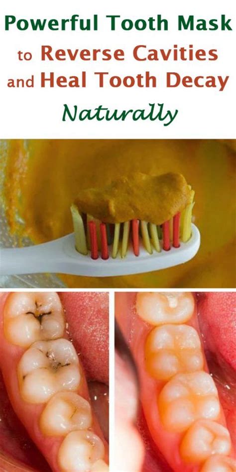 Prevents mineral loss in tooth enamel and replaces lost minerals; Reverse Cavities Naturally and Heal Tooth Decay with THIS ...
