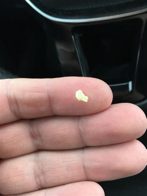 Coughed This Tonsil Stone Up Today Rpopping