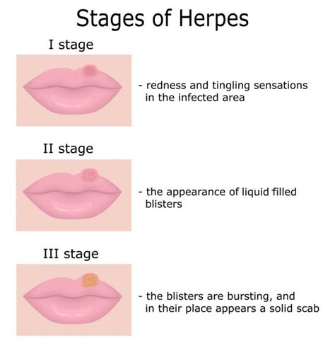 Herpes Simplex The Hidden Disease Facty Health