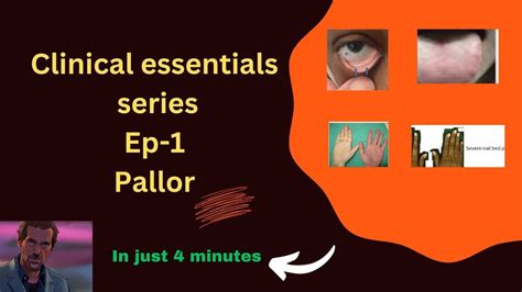 Pallor Clinics Series Episode 1 Mbbs Youtube