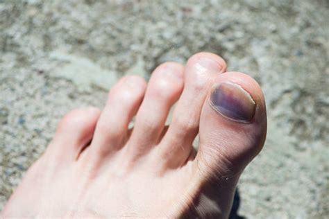 Toe Nail With Bruise Stock Photos Pictures And Royalty Free Images Istock