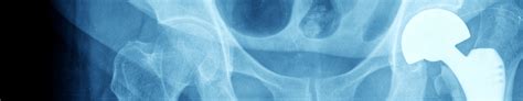 Depuy Hip Implant Recall Fort Myers Medical Device Lawyer
