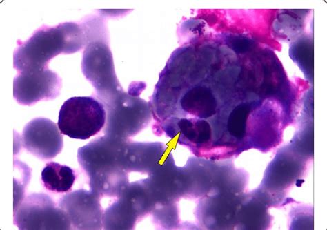 Wright Giemsa Stain Of The Patients Bone Marrow Aspirate With An Arrow