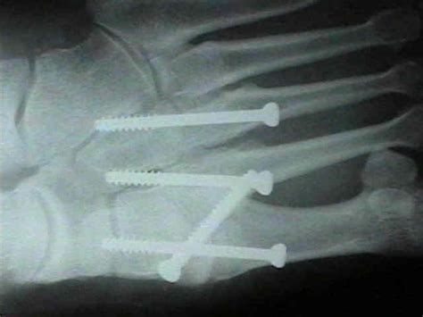 Orif Of Lisfrancs Fracture Wheeless Textbook Of Orthopaedics