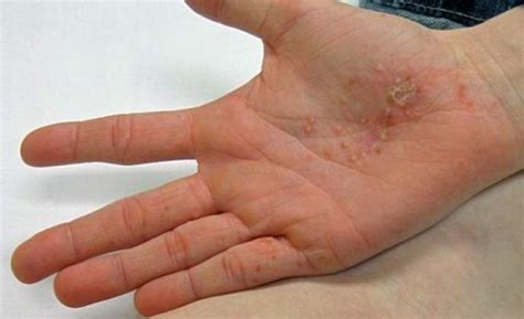 Dyshidrotic Eczema Pictures