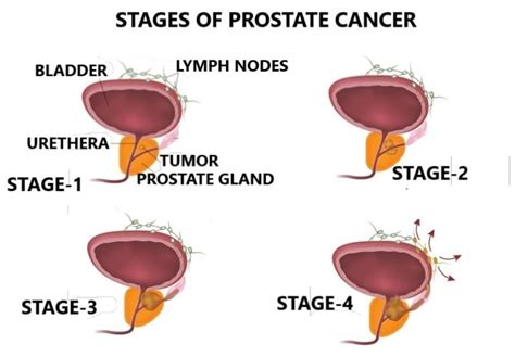 Symptoms Of Prostate Cancer What Psa Levels Should I Have Best Homeopathy Doctor In India