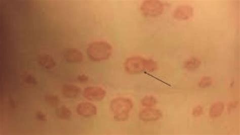Ringworm What Is It Symptoms And Signs
