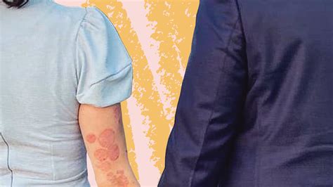 Everything You Need To Know About Psoriasis What Causes It What