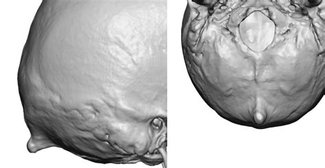 Occipital Knob Skull Deformity 3d Ct Scan Dr Barry Eppley Indianapolis