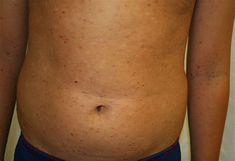 Dermatitis Herpetiformis Celiac Disease Hot Sex Picture