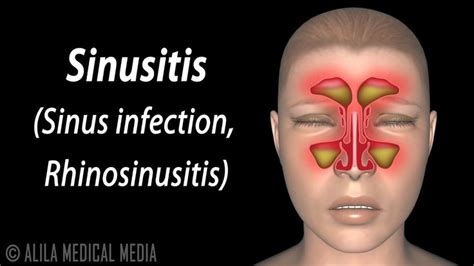 Sinusitis Animation Youtube Sinusitis Sinus Infection Chronic
