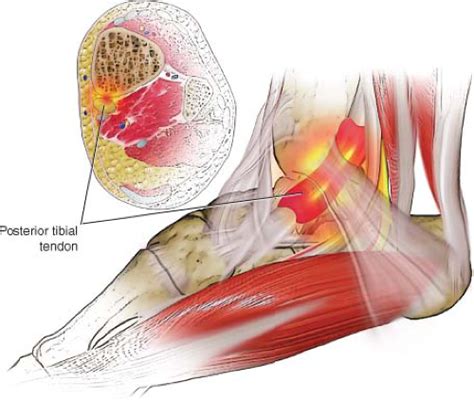 Posterior Tibialis Tendinitis And Other Abnormalities Of The Posterior Tibialis Tendon