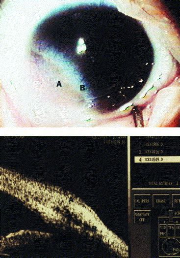 Ultrasound Biomicroscopy In The Diagnosis And Management Of Limbal
