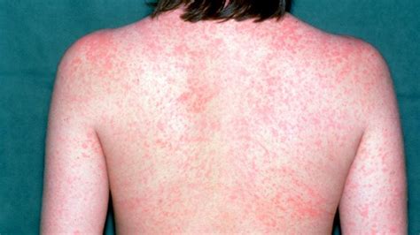 10 Essential Facts About Measles Everyday Health