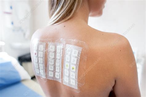 Patient Undergoing A Patch Test In Allergy Clinic Stock Image F0207295 Science Photo Library