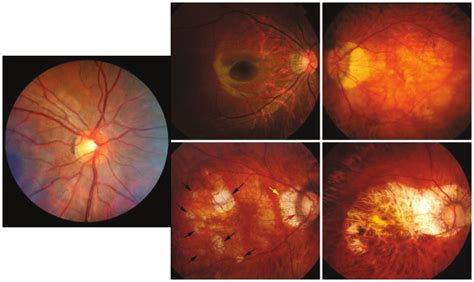 Myopic Maculopathy A Category 1 Fundus Tessellation Temporal To The
