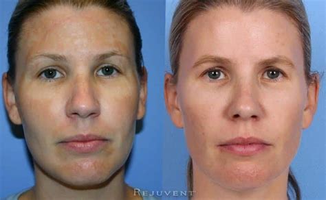 Before And After Photo Galleries • Rejuvent Medical Spa Scottsdale