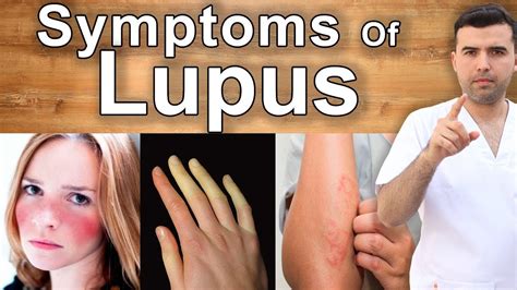 Diagnosing Lupus