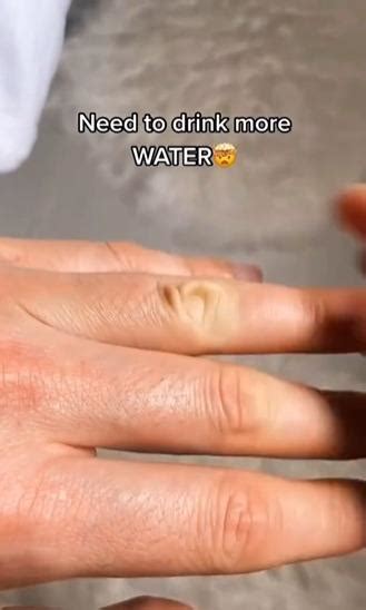 Doctors Skin Pinch Test Will Tell You If Youre Dehydrated