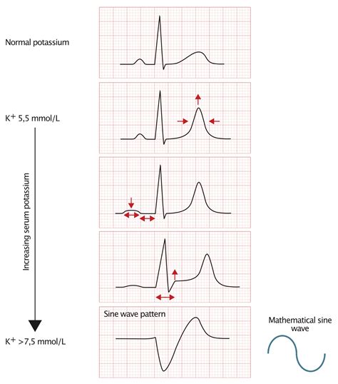 Ecg Changes Due To Electrolyte Imbalance Disorder Ecg And Echo
