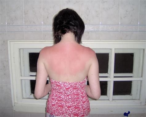 How To Treat A Sunburn Remedies For Sunburn Sun Burn Home Treatment