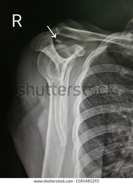 Check spelling or type a new query. Xray Imagelateral Scapula View Shows Right Stock Photo (Edit Now) 1585485292