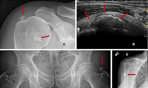 Clinical Evaluation And Management Of Calcific Tendinopathy An