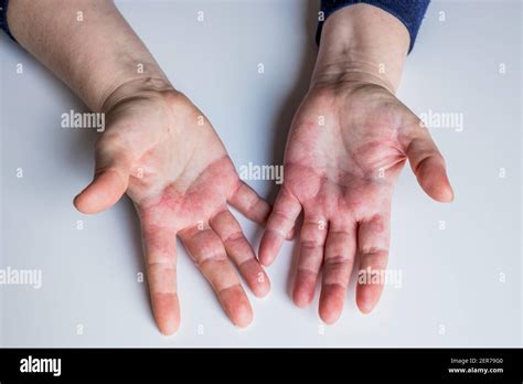 Dermatitis Atópica Roja Picazón En Las Manos Con Ampollas Y Piel