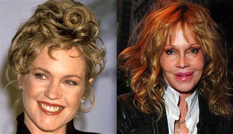 Melanie Griffith After Plastic Surgery